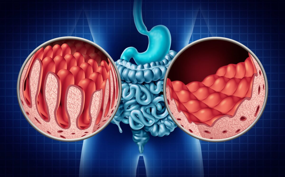 celiac-disease-1200x743.jpeg